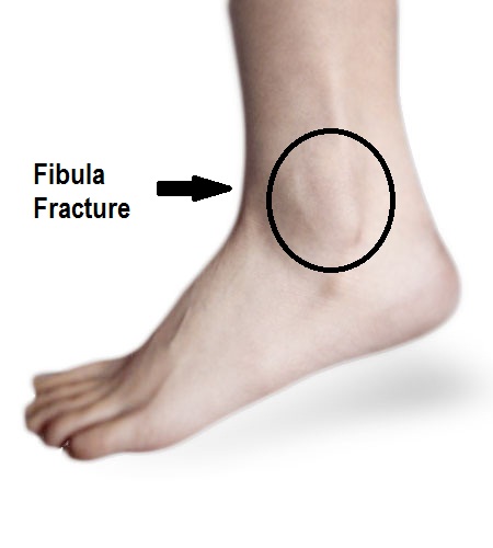 Distal Fibula Stress Fracture - with follow up · Virtual Fracture