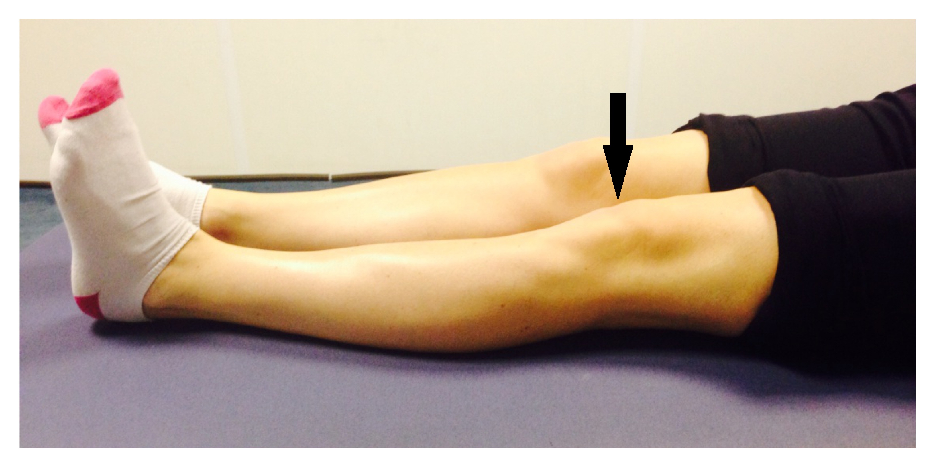 Broken patella hotsell recovery time